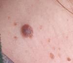 Родимка росте фото 1