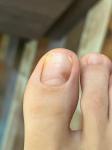 Коричневое пятно на ногте -это меланома? фото 2