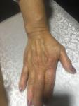 Артрит или артроз рук и ног фото 2