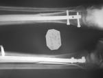 Винтообразный перелом большеберцовой кости фото 1
