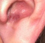 Воспаление в ушной раковине фото 2