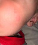 Воспаление на лице у ребёнка прыщ фото 1