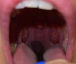 Ком в горле, оранжевые пятна на горле, миндалины асимметричны фото 1