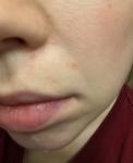 Периоральный дерматит, красные высыпания возле носа фото 1