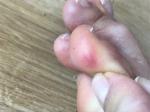 Воспаления на пальцах ног фото 2