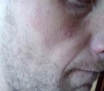 Шелушение кожи лица фото 2