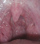 Оценка состояния миндалин и горло по фото фото 1