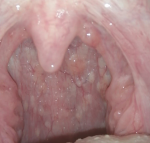 Оценка состояния миндалин и горло по фото фото 2