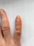 Инфекция Опух и покраснел палец после пореза болезненность бактерии фото 3