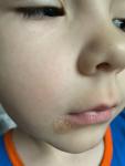 Покраснение и шелушение под губой у ребенка 5 лет фото 1