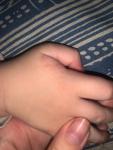 Мелкая сыпь на ручках у ребёнка 2 года фото 3
