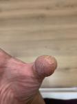 Экзема или дерматит на пальцах рук фото 3