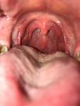 Сухость и боль в гортани, образования в горле фото 1