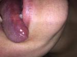 Пятно на языке после травмы фото 2