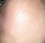 Сыпь на лице после умывалки фото 2