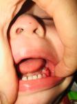 Нарост при прорезывании зуба фото 1