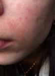 Красная мелкая сыпь в районе носа и губ фото 1