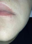 Странное воспаление на внутренней стороне губы фото 1