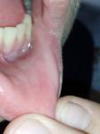 Странное воспаление на внутренней стороне губы фото 3