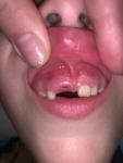Молочный зуб фото 2