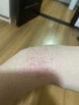 Сухой участок на руке, как аллергия фото 2