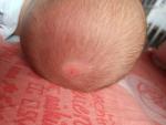 Пятно на голове у новорождённого фото 1