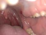 Бордовое пятно во рту у десны фото 2