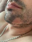 Очаговая алопеция на бороде фото 1