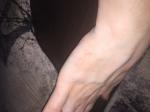 Сыпь на руке в виде папул фото 3