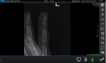 Перелом ногтевой фаланги пальца фото 2