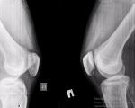 Травма коленных суставов фото 2