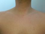 Мелкая красная сыпь на груди фото 2