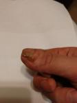 Коррекция ногтевой пластины фото 2