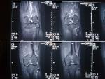 Операция при боли в колене фото 5