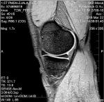 Травма колена, синовит фото 2