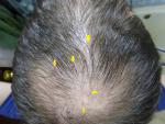 Прыщи и покраснения в волосистой части головы фото 2