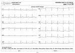 РасшифровкаЭКГ фото 2
