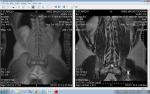 Остеохондроз позвоночника, болит спина и нога фото 1