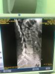 Болит спина сколиоз левосторонний возвроночника фото 2
