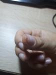 Проблемы с кожей на пальцах рук вокруг ногтей фото 2