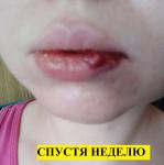 Травма губы (последствия спустя месяц) фото 18+ фото 2