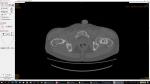Энхондрома шейки левой бедренной кости фото 1