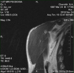 Правый плечевой сустав Хилл-Сакс фото 5