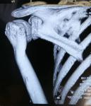 Деформация плечевой кости фото 3