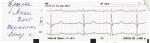ЭКГ ребенка расшифровка фото 2