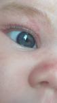 Пятнышко на роговице глаза у ребёнка фото 2