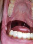 Воспаление в полости рта, после увулита фото 2