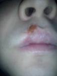 Гематома на лице и верхней губе, боль в ухе фото 2