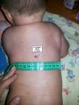 Гемангиома на спине у ребенка 3 месяца фото 3
