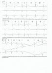 Экстрасистолы и выпадения комплексов QRST фото 2